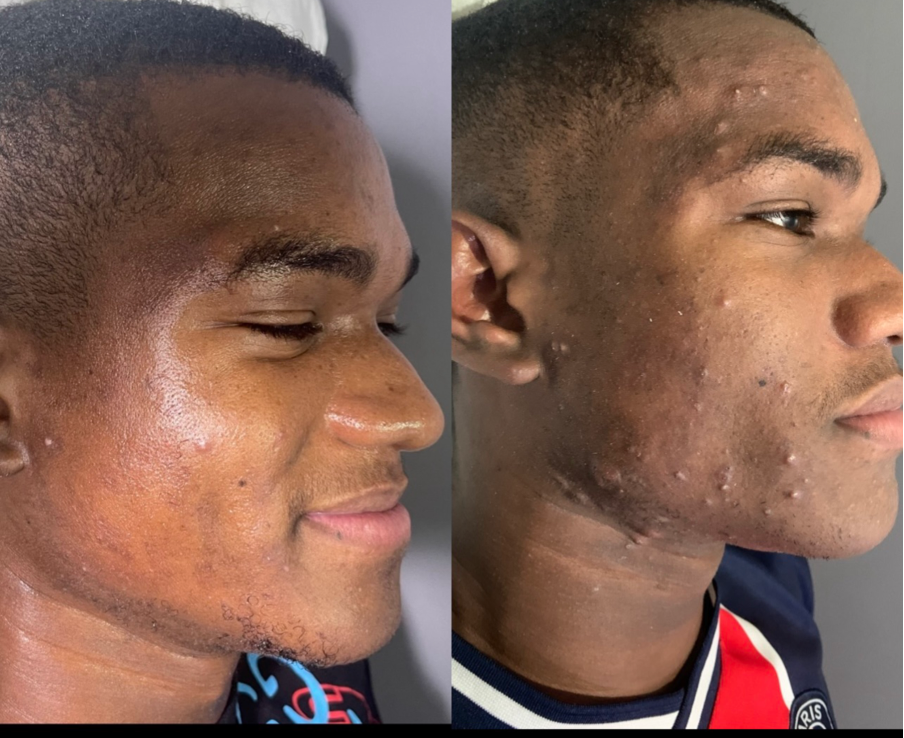 Before and after acne and scarring treatment result from The Skin Lab Jamaica