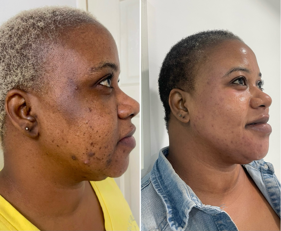 Before and after acne and post-inflammatory hyperpigmentation treatment result from The Skin Lab Jamaica