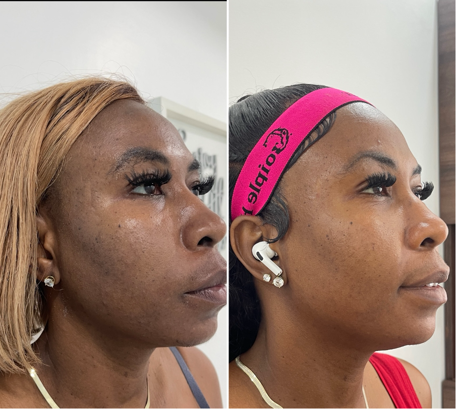 Before and after skin rejuvenation treatment result from The Skin Lab Jamaica